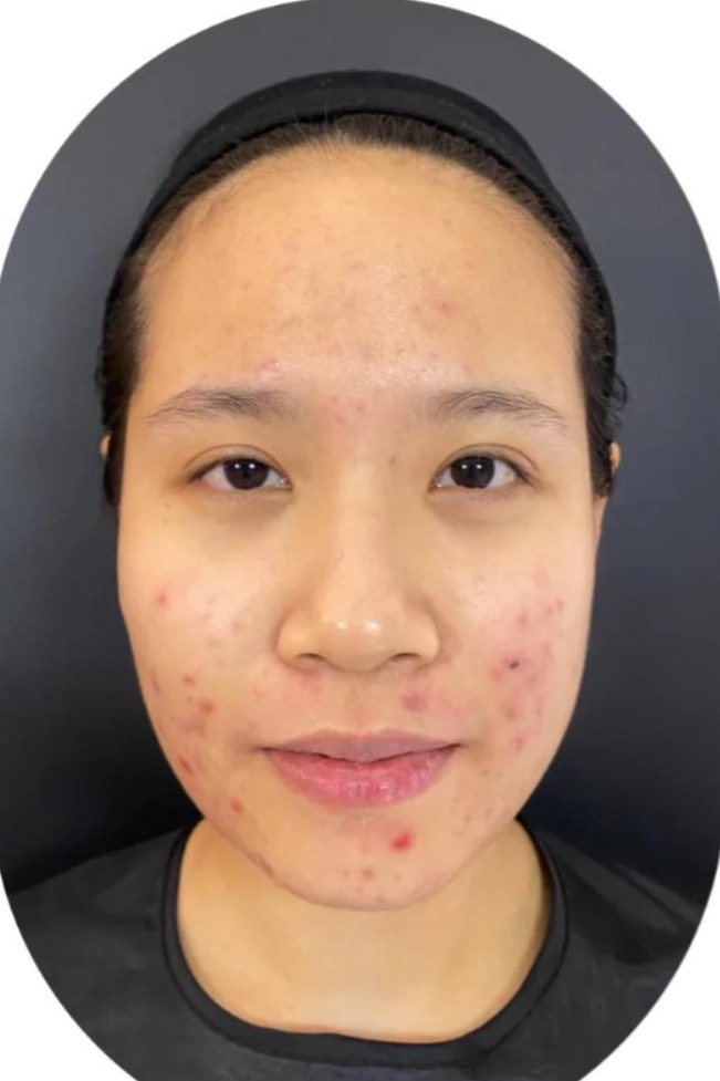 Best acne treatment in narmadapuram 