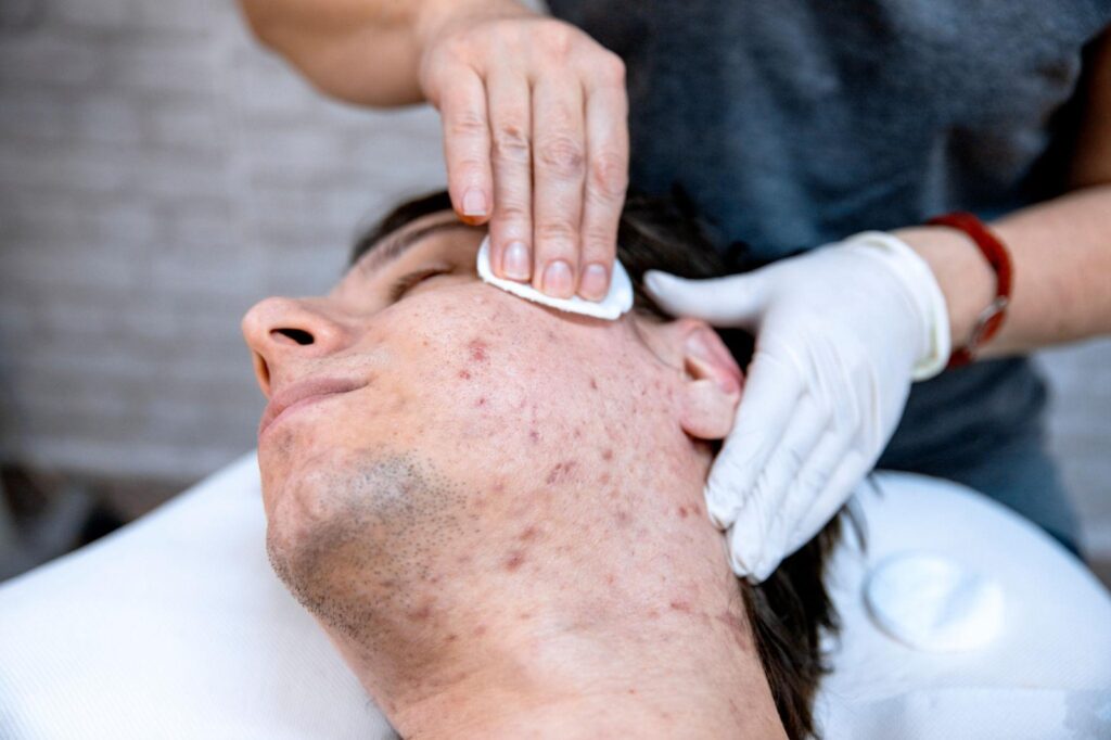 best acne dr. in narmadapuram 